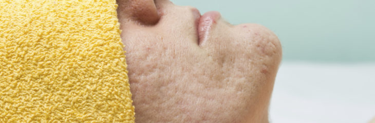 tratar cicatrizes de acne
